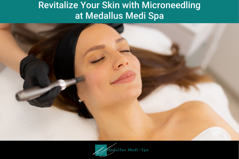 Revitalize Your Skin with Microneedling at Medallus Medi Spa