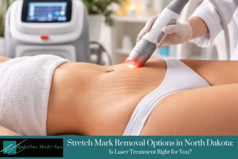 Stretch Mark Removal Options in North Dakota: Is Laser Treatment Right for You?