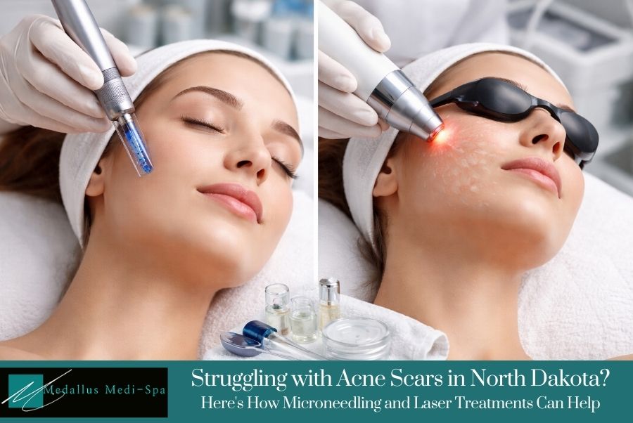 Struggling with Acne Scars in North Dakota? Here's How Microneedling and Laser Treatments Can Help